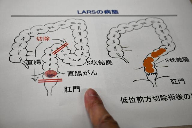 低位前方切除後症候群(LARS)の概念図